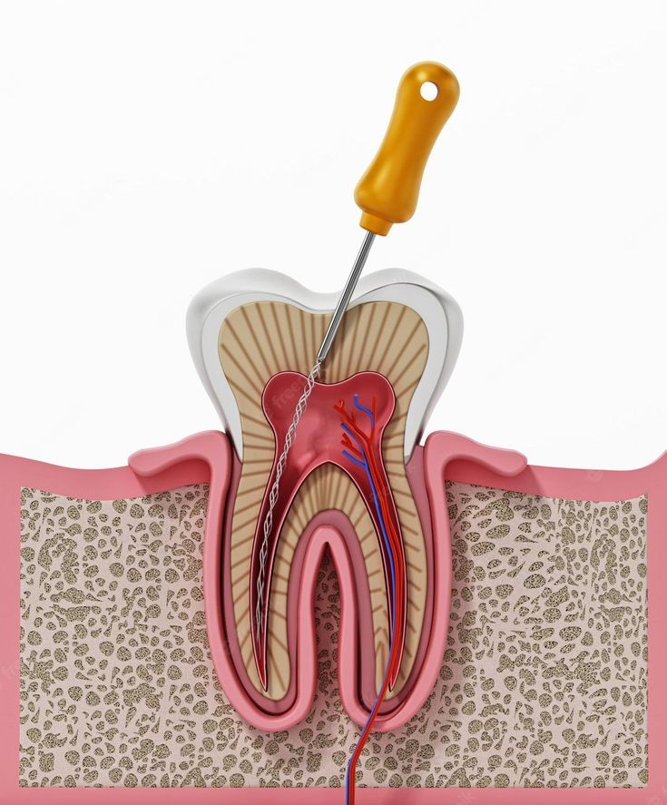 Root Canal Treatment Banner